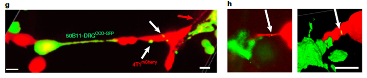 La Conexión Siniestra: Neuronas “Alimentan” a Células de Cáncer con sus Mitocondrias para Impulsar la Metástasis