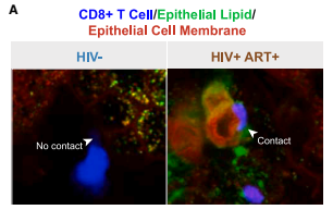 Vampiros Celulares: El Sorprendente Secreto de por qué el VIH sigue dañando el intestino, incluso con tratamiento